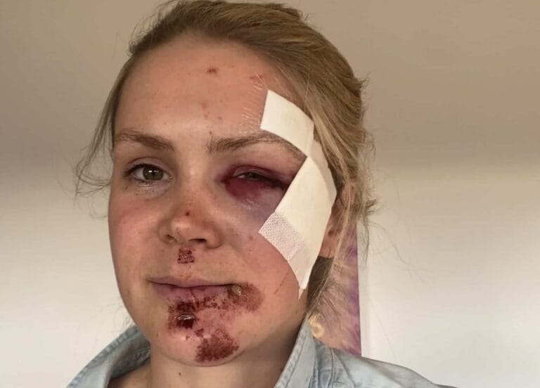 Karoline Knotten skadet i stygg sykkelvelt